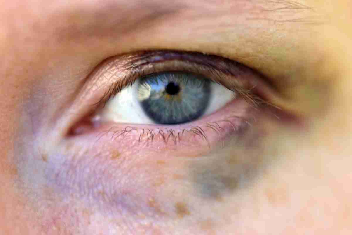 Como Tirar Hematomas do Olho? Saiba as causas e dicas caseiras de como trata