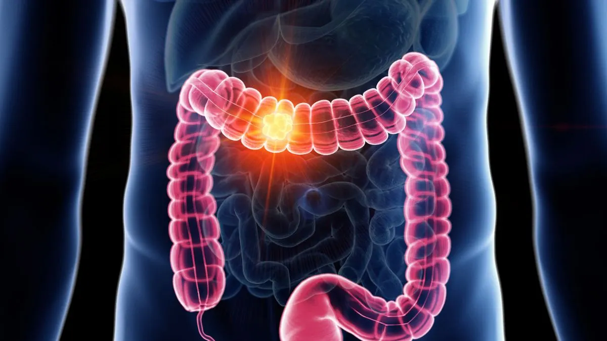 Xifaxan: o antibiótico que vai além do que você imagina
