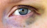 Como Tirar Hematomas do Olho? Saiba as causas e dicas caseiras de como trata